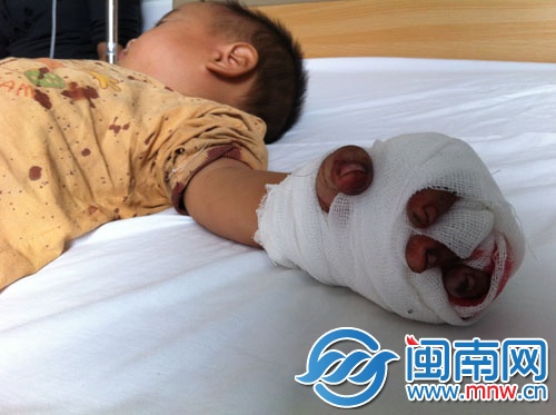 小園的左手無(wú)名指被三輪電動(dòng)車鏈條絞斷